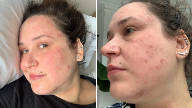 rebecca-armstrong-found-that-her-eczema-flared-up-but-her-gp-wouldnt-help-photo-supplied
