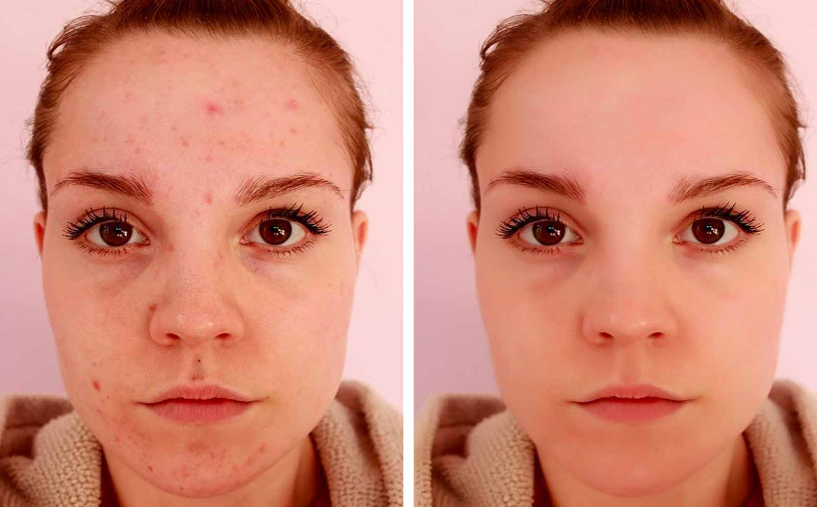 skin-blemish-removal-before-after